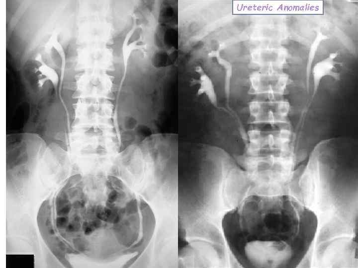 Ureteric Anomalies 