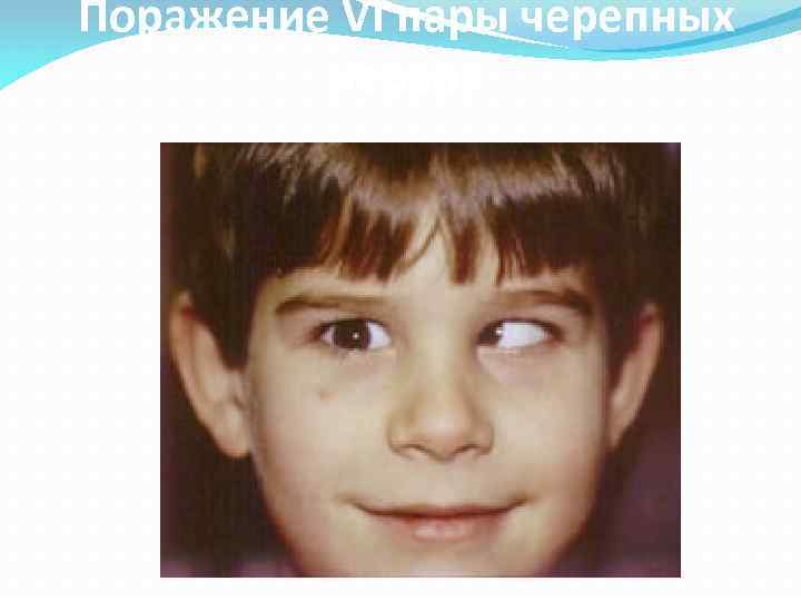 Поражение VI пары черепных нервов 