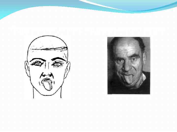 Поражение левого подъязычного нерва 