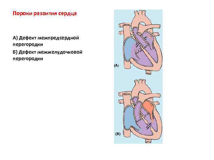 Пороки развития сердца А) Дефект межпредсердной перегородки Б) Дефект межжелудочковой перегородки 