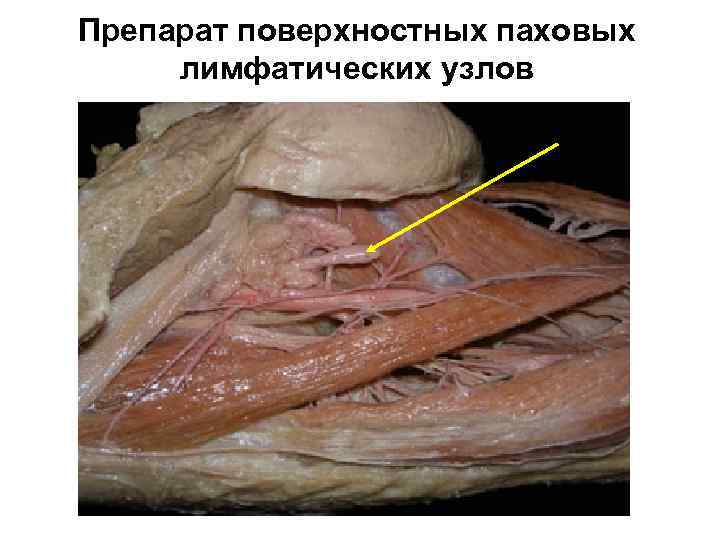 Препарат поверхностных паховых лимфатических узлов 