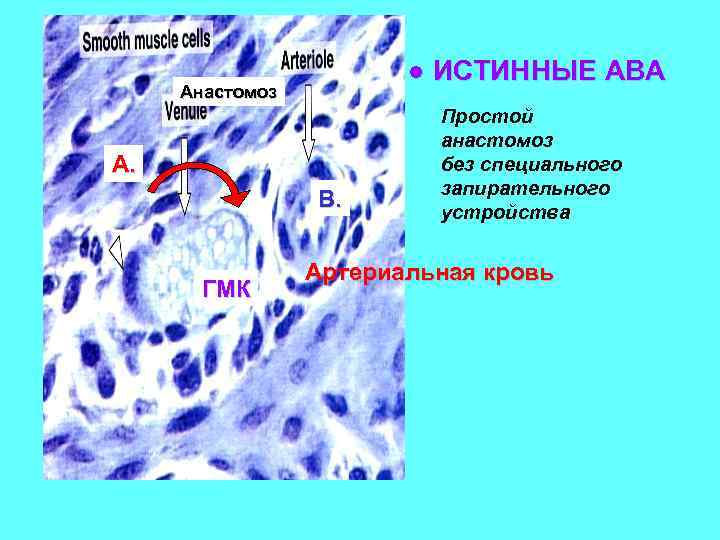 ● ИСТИННЫЕ АВА Анастомоз А. В. ГМК Простой анастомоз без специального запирательного устройства Артериальная