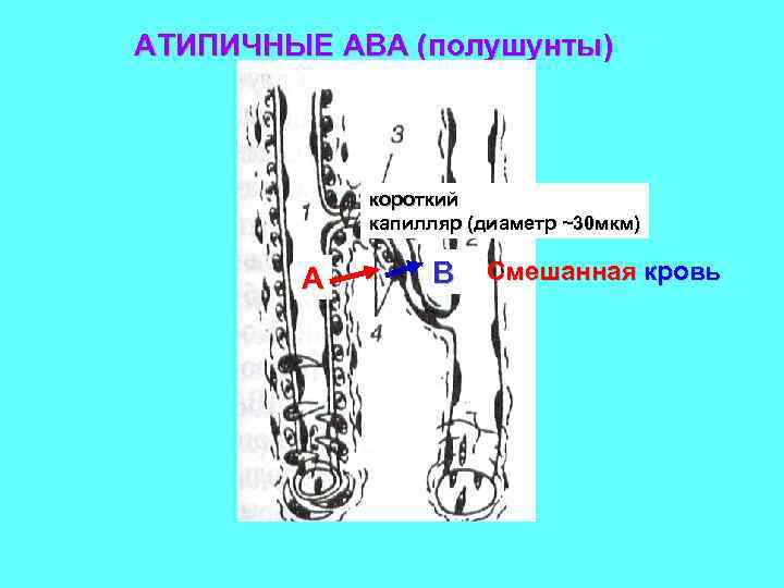 АТИПИЧНЫЕ АВА (полушунты) короткий капилляр (диаметр ~30 мкм) А В Смешанная кровь 