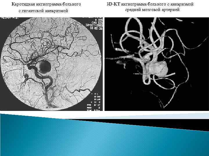  Каротидная ангиограмма больного с гигантской аневризмой 3 D-KT ангиограмма больного с аневризмой средней
