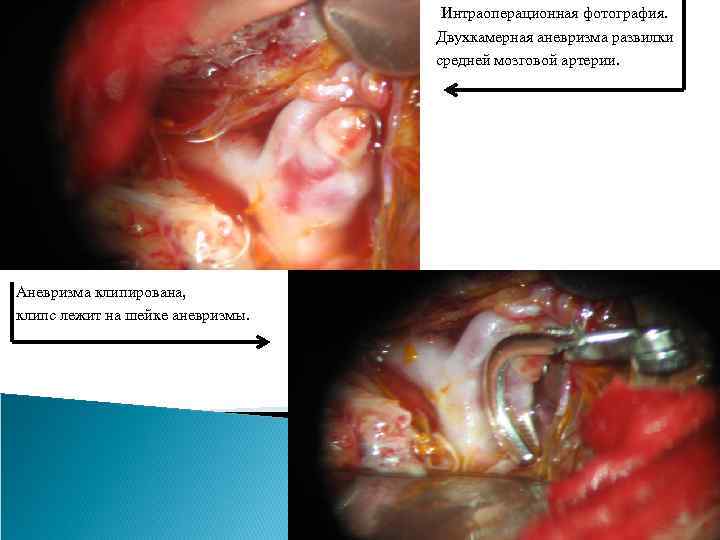 Интраоперационная фотография. Двухкамерная аневризма развилки средней мозговой артерии. Аневризма клипирована, клипс лежит на шейке