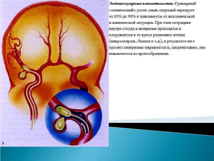 Аневризма головного мозга эндоваскулярным