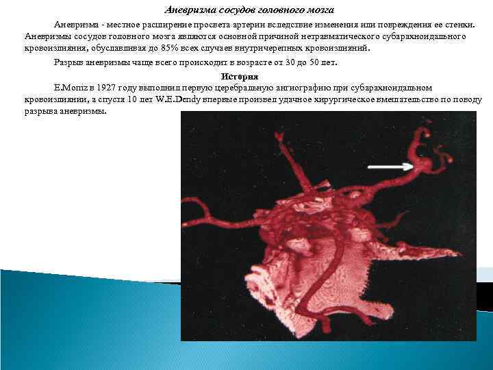 Аневризма сосудов головного мозга Аневризма - местное расширение просвета артерии вследствие изменения или повреждения