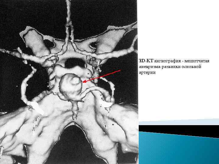 ЗD-KT ангиография - мешотчатая аневризма развилки основной артерии 