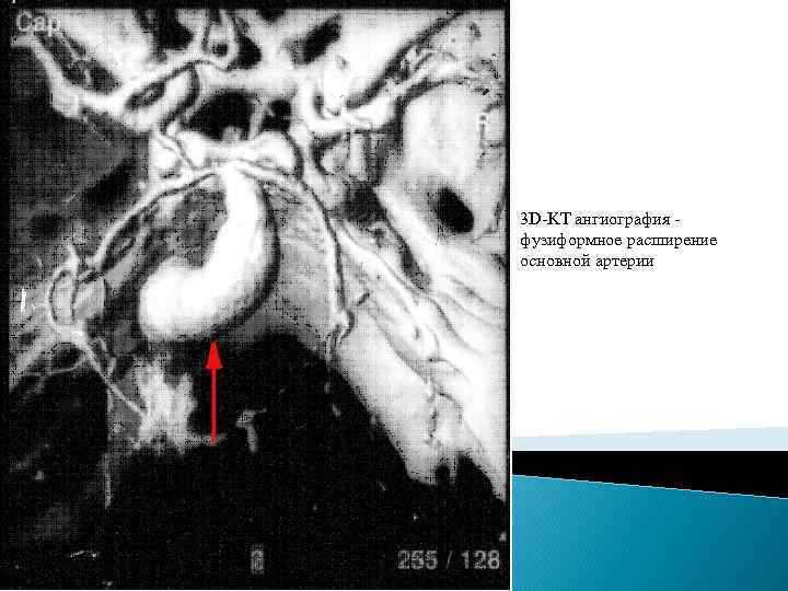 3 D-KT ангиография - фузиформное расширение основной артерии 