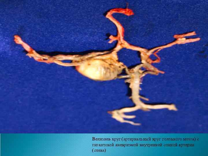 Велизиев круг (артериальный круг головного мозга) с гигантской аневризмой внутренней сонной артерии (слева) 
