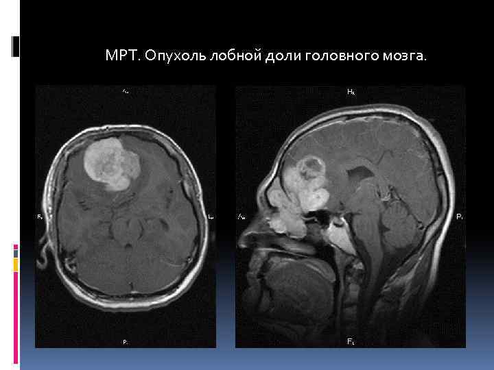 МРТ. Опухоль лобной доли головного мозга. 