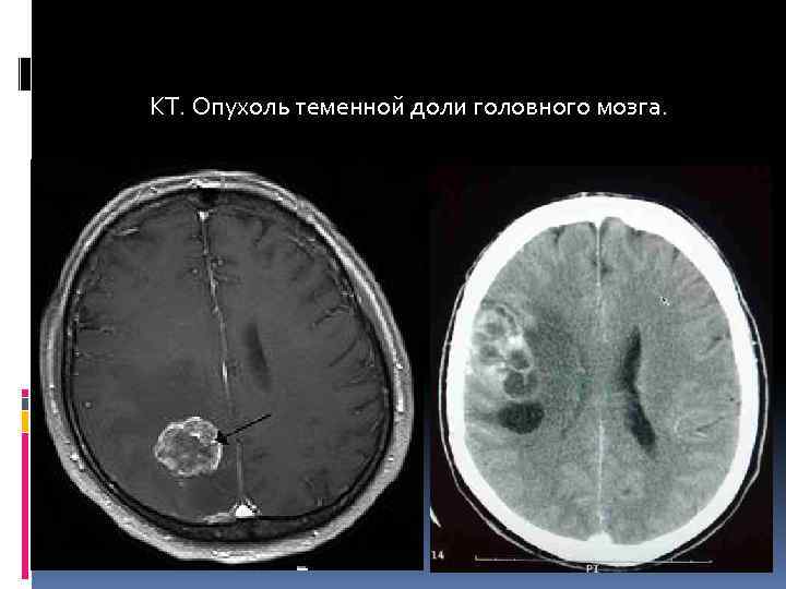 КТ. Опухоль теменной доли головного мозга. 