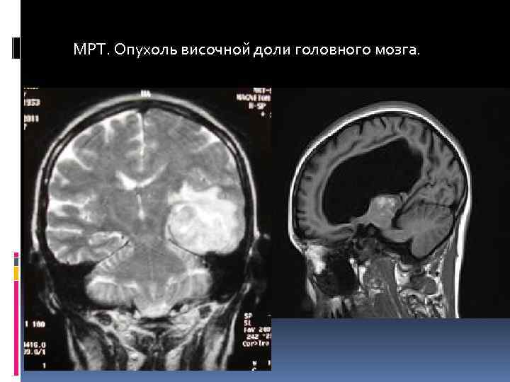 МРТ. Опухоль височной доли головного мозга. 