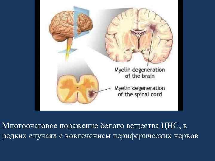 Многоочаговое поражение белого вещества ЦНС, в редких случаях с вовлечением периферических нервов 