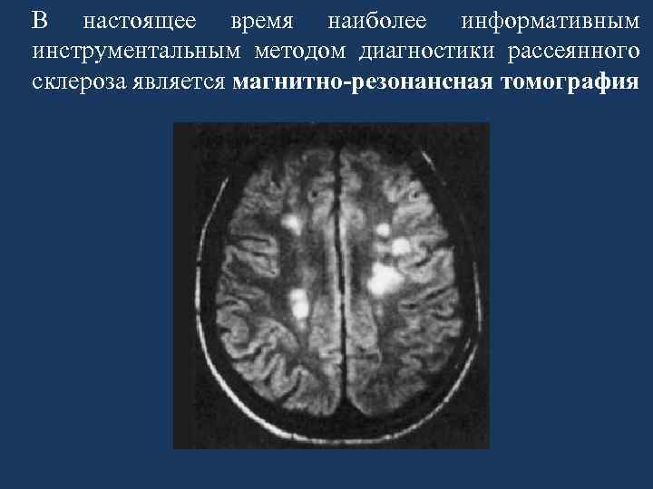 В настоящее время наиболее информативным инструментальным методом диагностики рассеянного склероза является магнитно-резонансная томография 