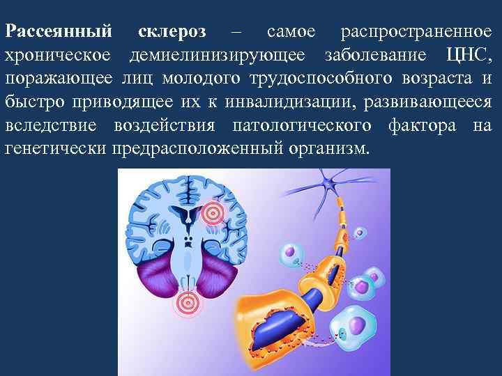 Рассеянный склероз – самое распространенное хроническое демиелинизирующее заболевание ЦНС, поражающее лиц молодого трудоспособного возраста