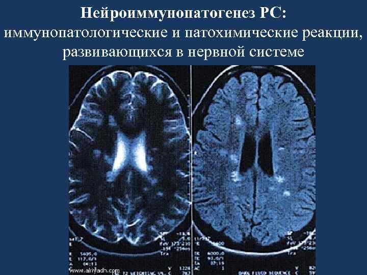 Нейроиммунопатогенез РС: иммунопатологические и патохимические реакции, развивающихся в нервной системе 
