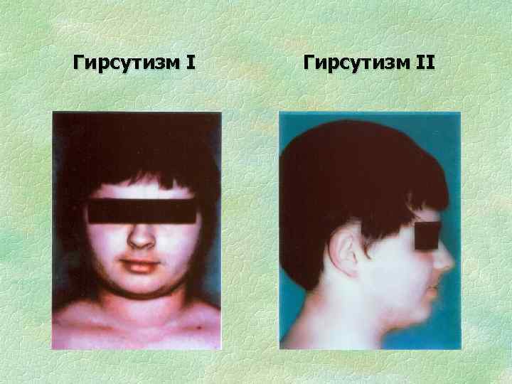 Гирсутизм II 