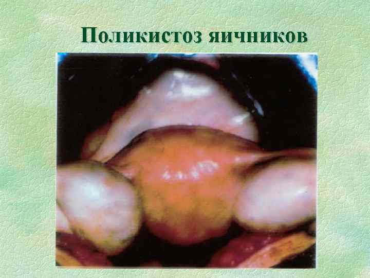 Поликистоз яичников 