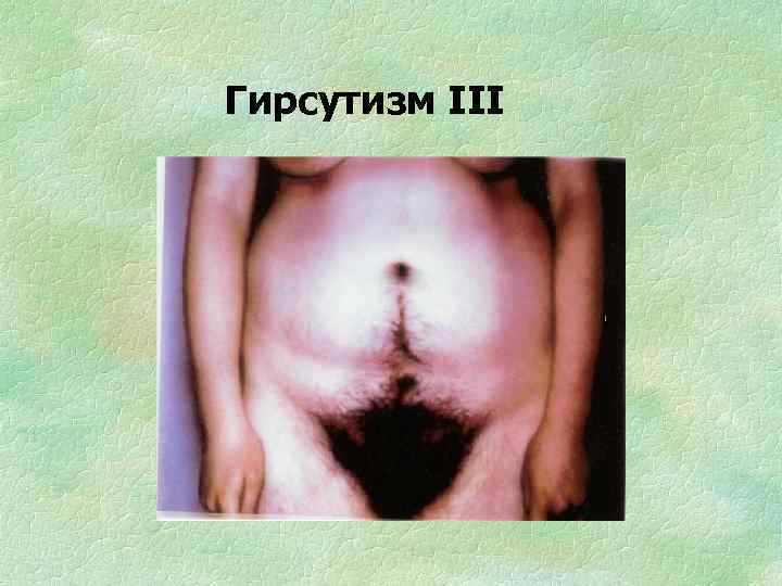 Гирсутизм III 