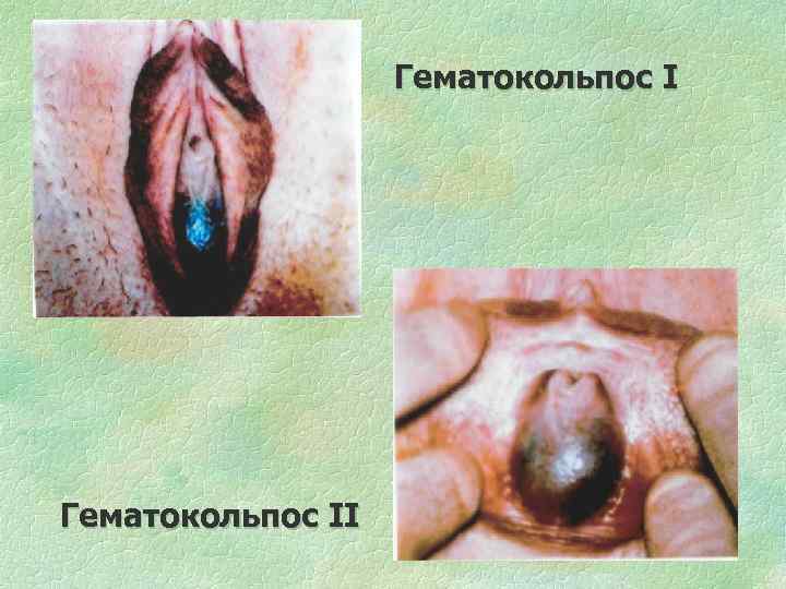 Гематокольпос II 