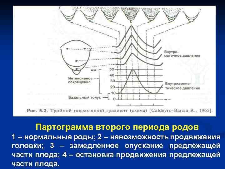 Партограмма второго периода родов 1 – нормальные роды; 2 – невозможность продвижения головки; 3