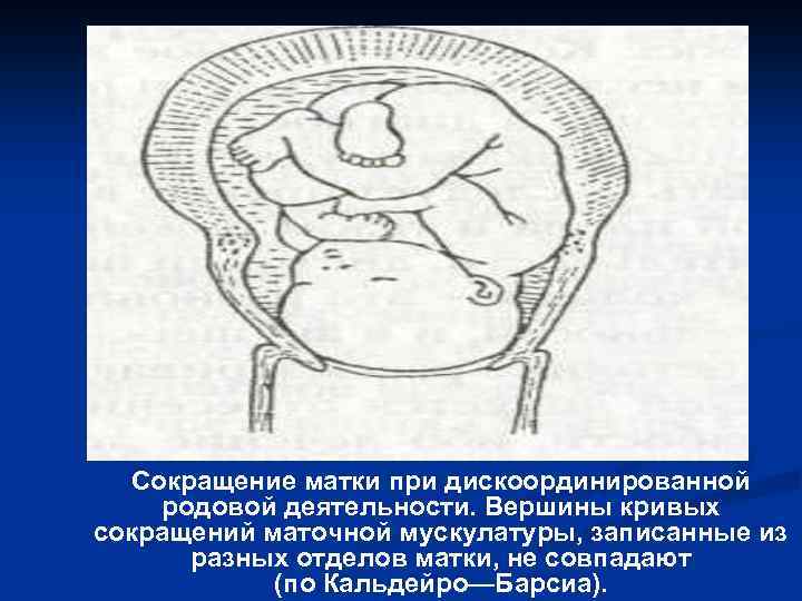 Сокращение матки при дискоординированной родовой деятельности. Вершины кривых сокращений маточной мускулатуры, записанные из разных