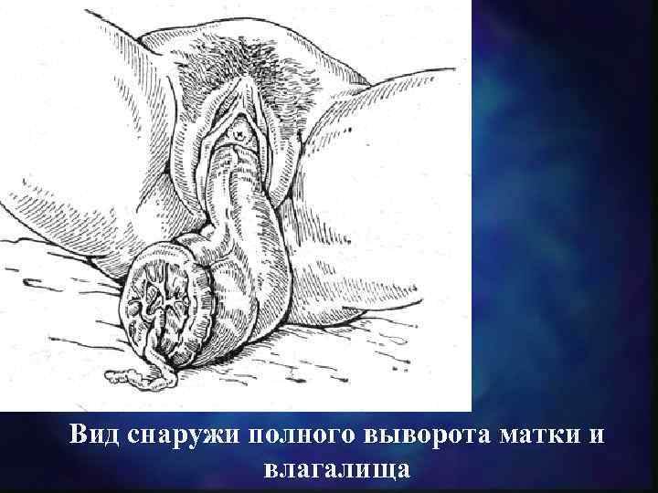 Вид снаружи полного выворота матки и влагалища 
