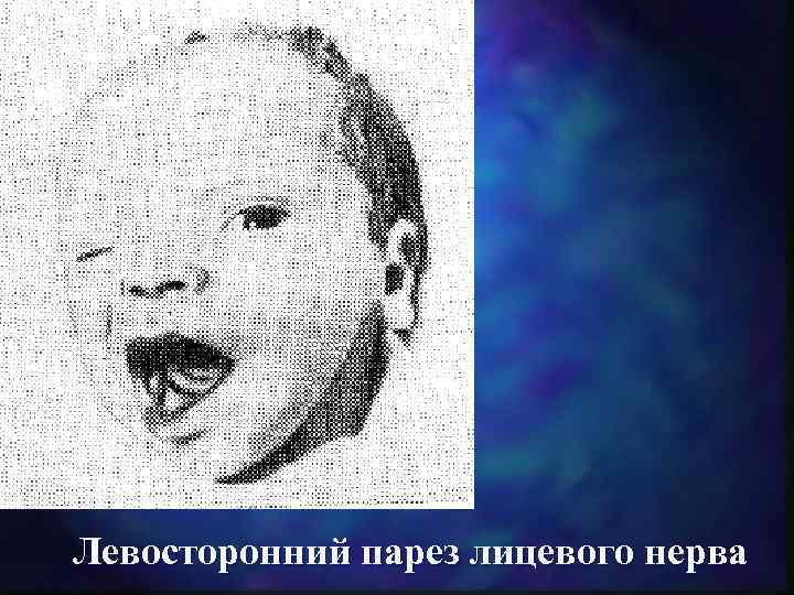 Левосторонний парез лицевого нерва 