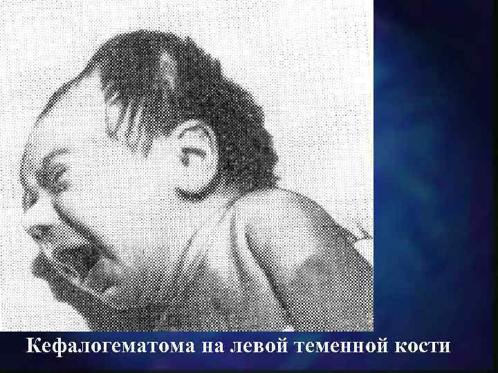 Кефалогематома на левой теменной кости 