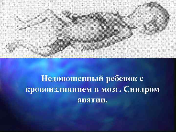 Недоношенный ребенок с кровоизлиянием в мозг. Синдром апатии. 