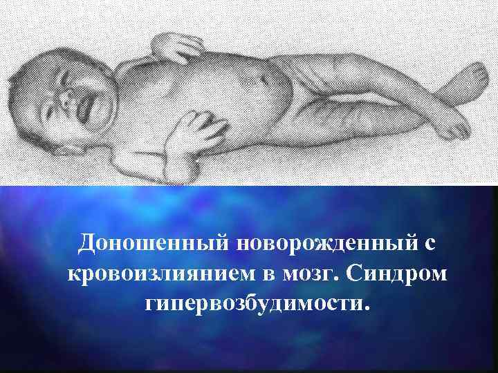 Доношенный новорожденный с кровоизлиянием в мозг. Синдром гипервозбудимости. 