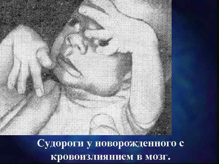 Судороги у новорожденного с кровоизлиянием в мозг. 