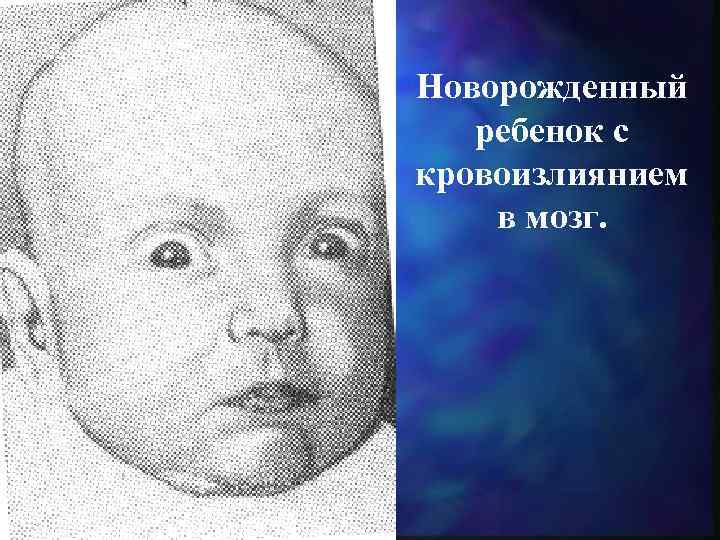 Новорожденный ребенок с кровоизлиянием в мозг. 