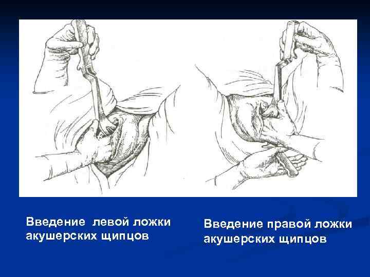 Введение правой ложки Введение левой ложки Введение правой ложки акушерских щипцов 