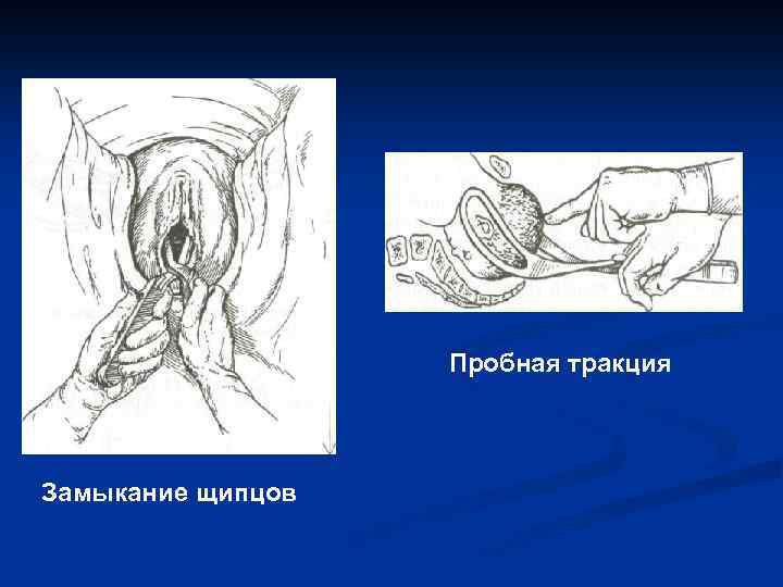 Пробная тракция Замыкание щипцов 