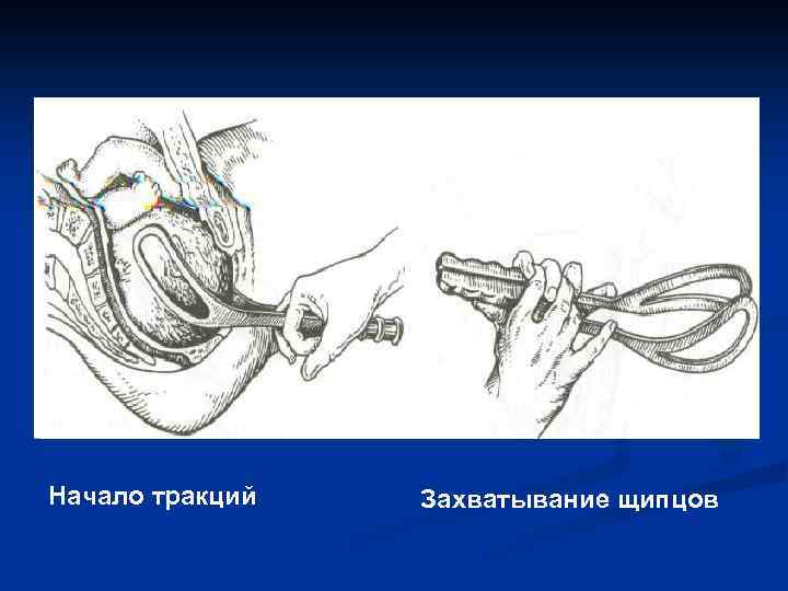 Начало тракций Захватывание щипцов 