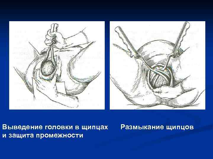 Выведение головки в щипцах и защита промежности Размыкание щипцов 