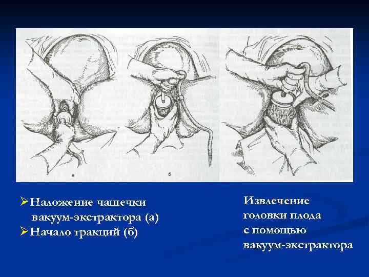 Вакуум экстракция плода презентация