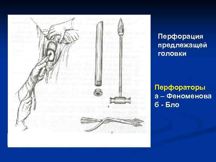 Перфорация предлежащей головки Перфораторы а – Феноменова б - Бло 