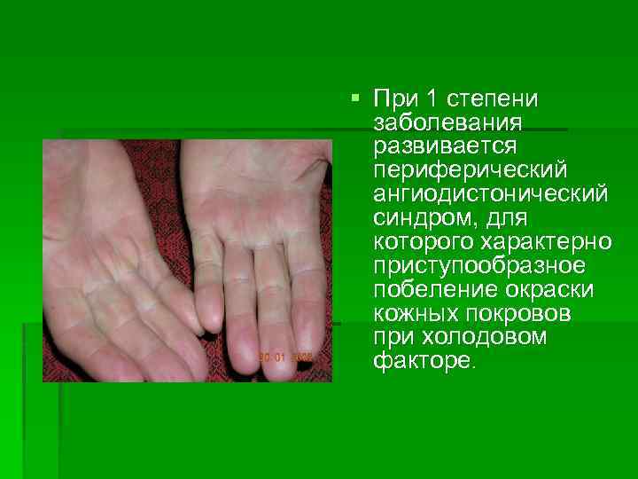 § При 1 степени заболевания развивается периферический ангиодистонический синдром, для которого характерно приступообразное побеление