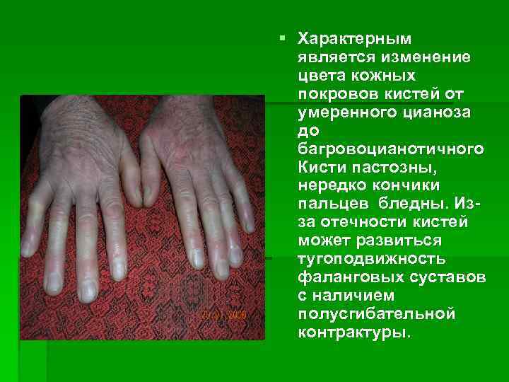 § Характерным является изменение цвета кожных покровов кистей от умеренного цианоза до багровоцианотичного Кисти