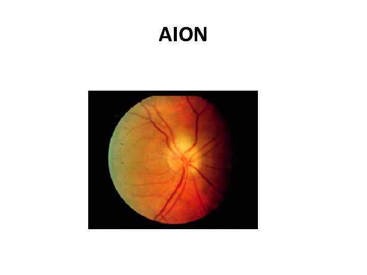 AION 