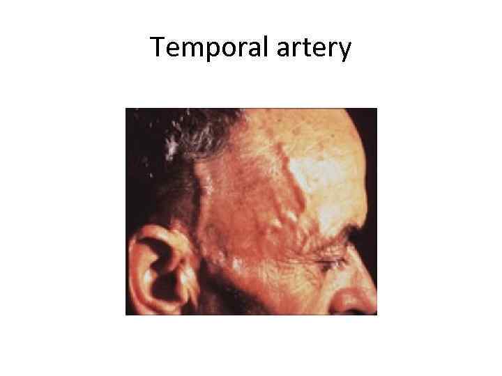 Temporal artery 