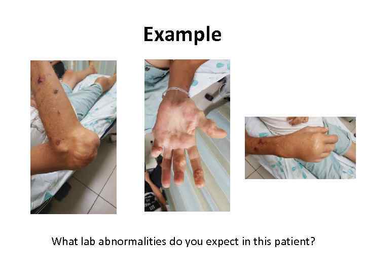 Example What lab abnormalities do you expect in this patient? 