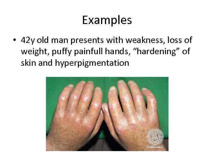 Examples • 42 y old man presents with weakness, loss of weight, puffy painfull