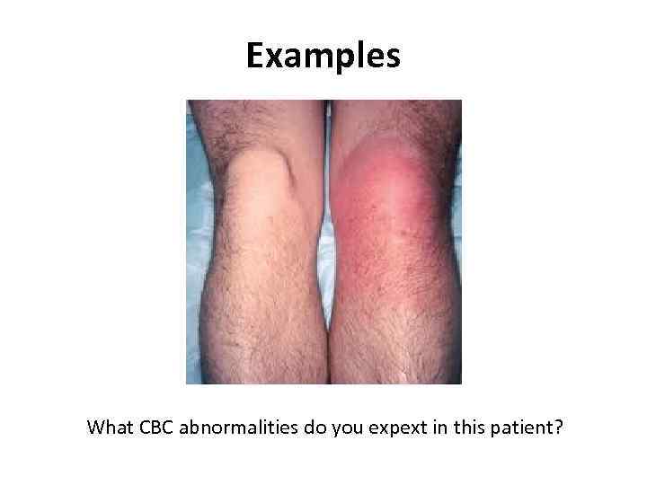 Examples What CBC abnormalities do you expext in this patient? 