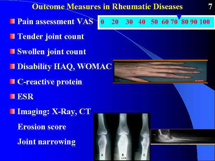 Outcome Measures in Rheumatic Diseases 7 Pain assessment VAS 0 20 30 40 50