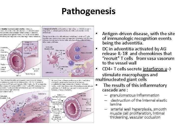 Pathogenesis • Antigen-driven disease, with the site of immunologic recognition events being the adventitia.