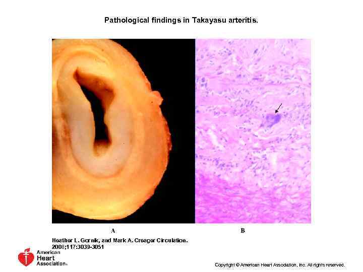 Pathological findings in Takayasu arteritis. Heather L. Gornik, and Mark A. Creager Circulation. 2008;